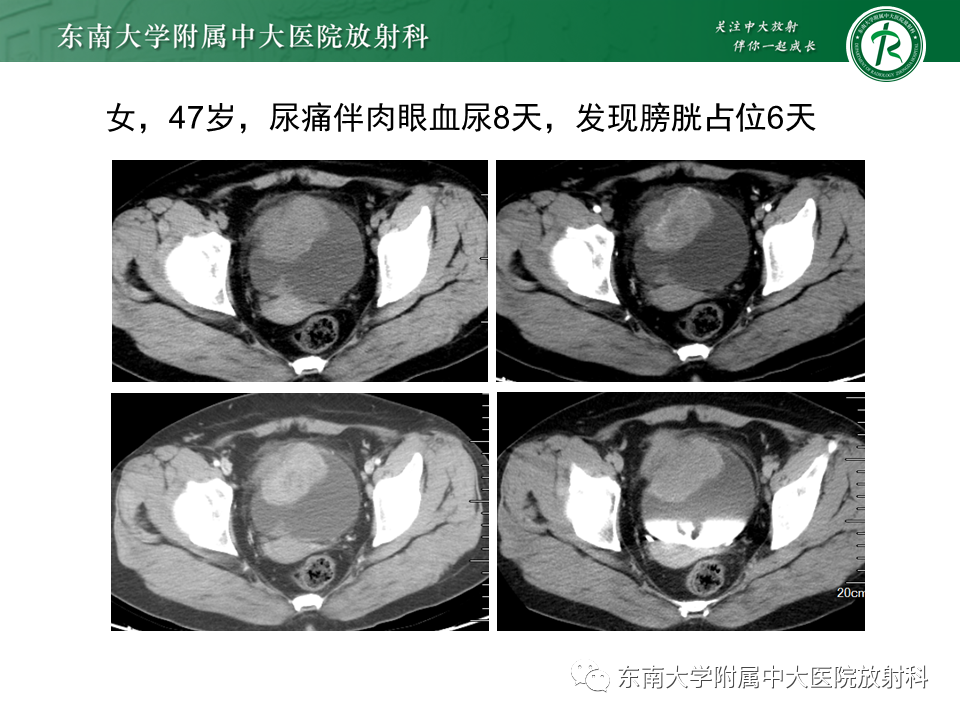 影像PPT - 【PPT】膀胱平滑肌瘤-18