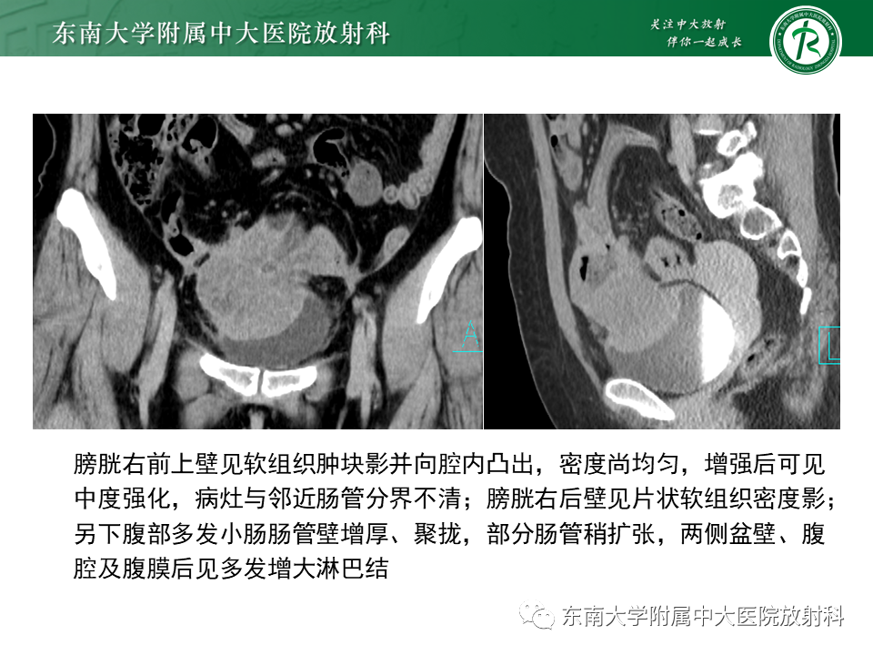 影像PPT - 【PPT】膀胱平滑肌瘤-19