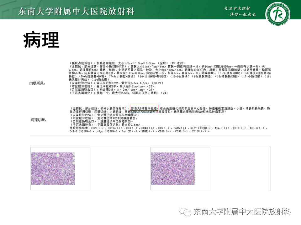 影像PPT - 【PPT】膀胱平滑肌瘤-20