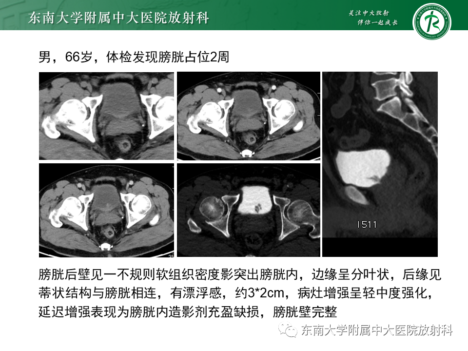 影像PPT - 【PPT】膀胱平滑肌瘤-22