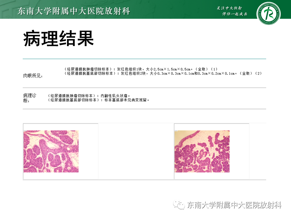 影像PPT - 【PPT】膀胱平滑肌瘤-23