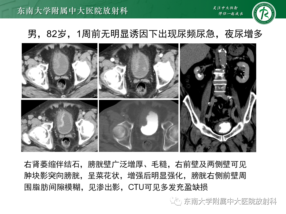 影像PPT - 【PPT】膀胱平滑肌瘤-26