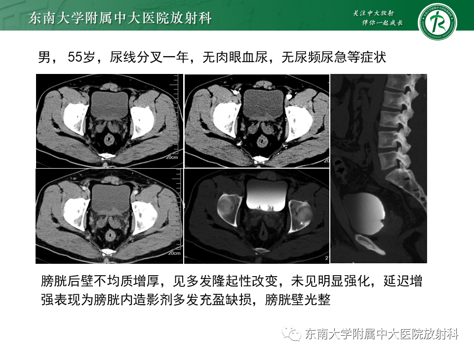 影像PPT - 【PPT】膀胱平滑肌瘤-30