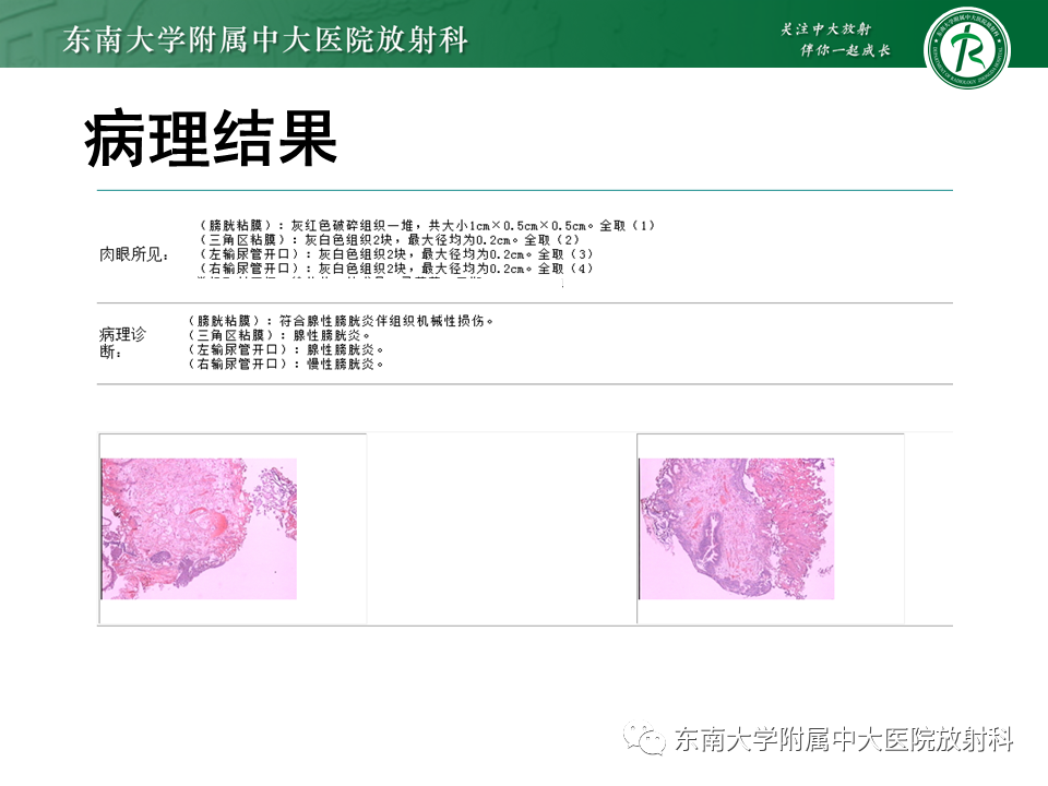影像PPT - 【PPT】膀胱平滑肌瘤-31