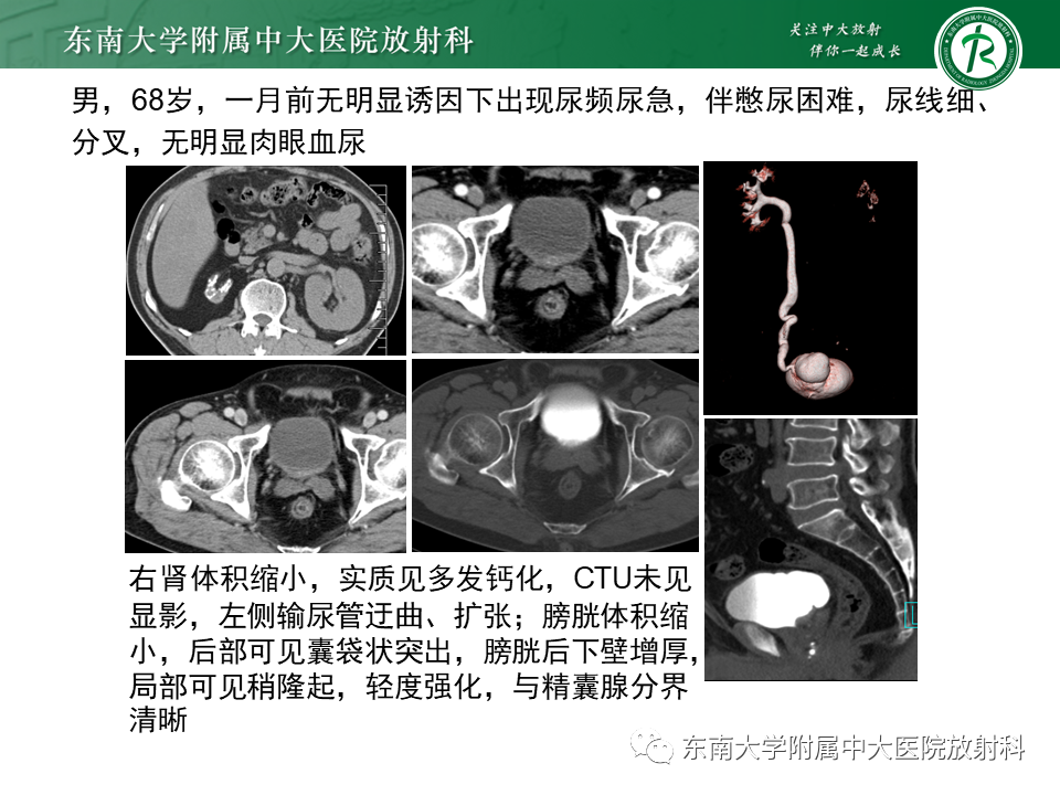 影像PPT - 【PPT】膀胱平滑肌瘤-34