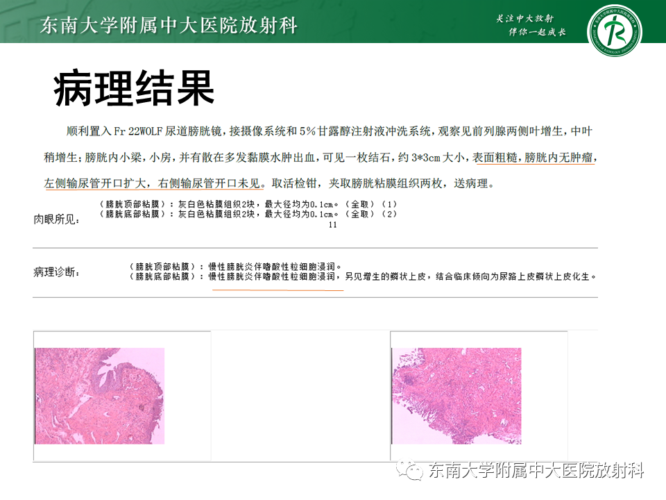 影像PPT - 【PPT】膀胱平滑肌瘤-35