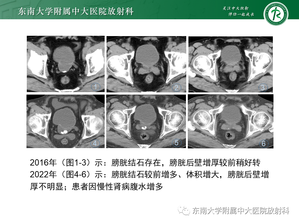 影像PPT - 【PPT】膀胱平滑肌瘤-36