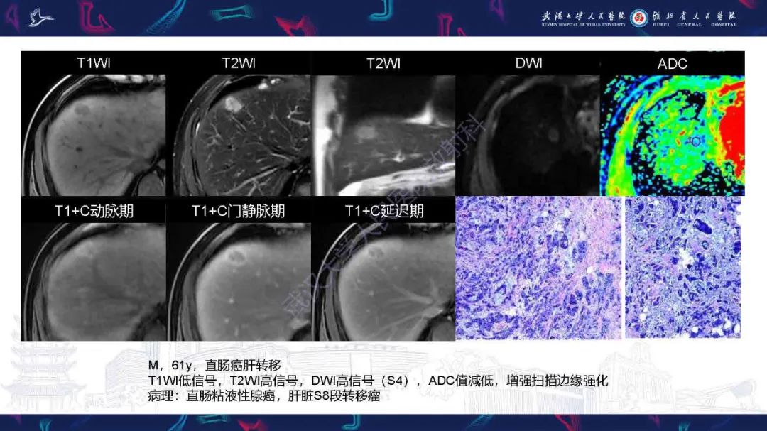 影像PPT - 【PPT】结直肠癌肝转移影像诊断-2