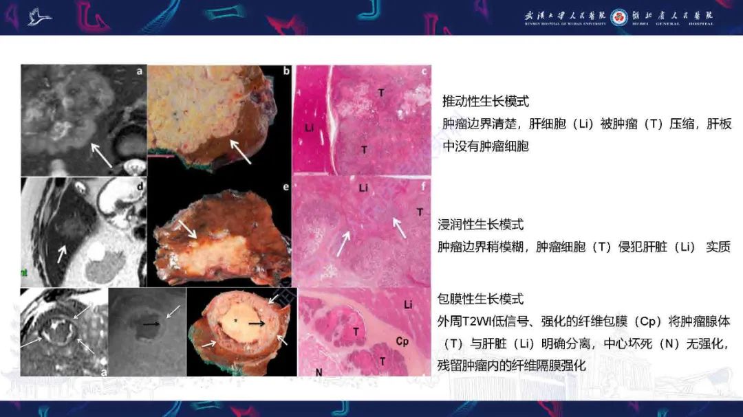 影像PPT - 【PPT】结直肠癌肝转移影像诊断-5