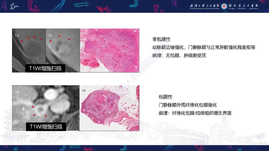 影像PPT - 【PPT】结直肠癌肝转移影像诊断-6
