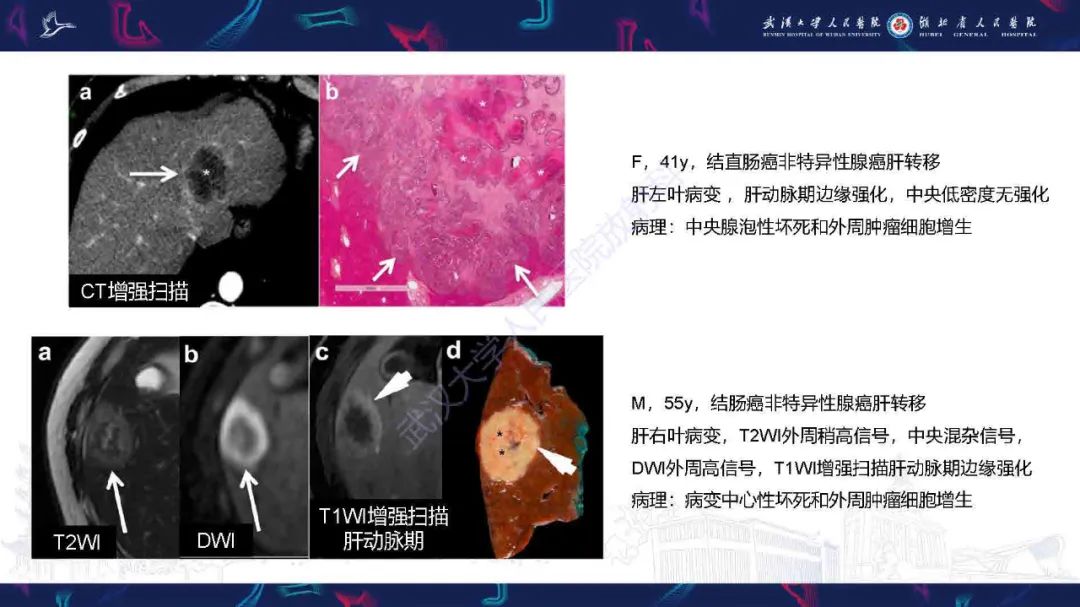 影像PPT - 【PPT】结直肠癌肝转移影像诊断-9