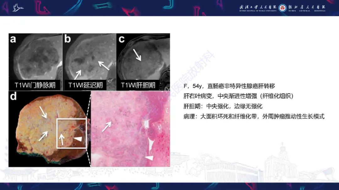 影像PPT - 【PPT】结直肠癌肝转移影像诊断-10