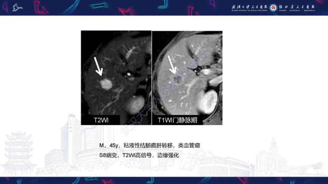 影像PPT - 【PPT】结直肠癌肝转移影像诊断-12
