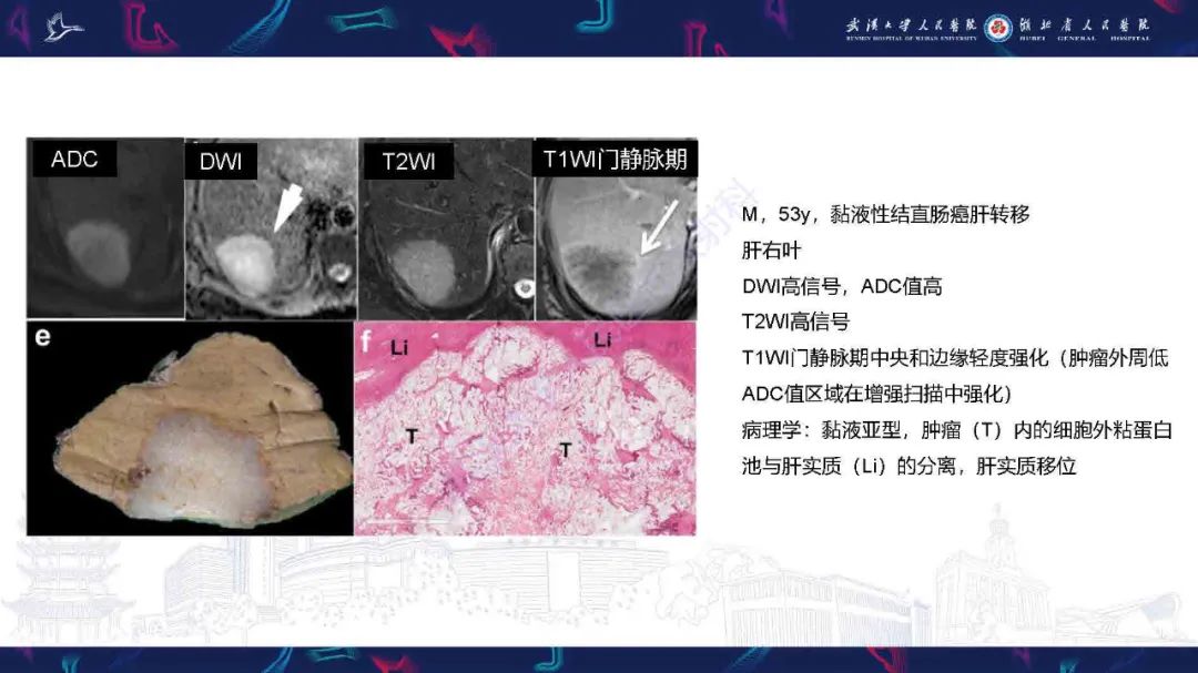 影像PPT - 【PPT】结直肠癌肝转移影像诊断-13