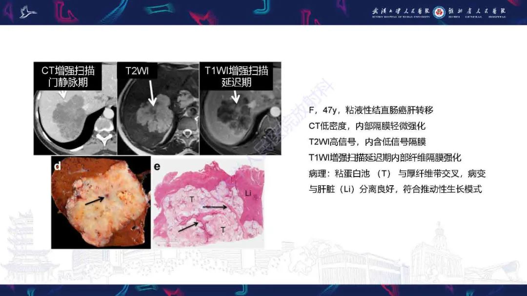 影像PPT - 【PPT】结直肠癌肝转移影像诊断-14