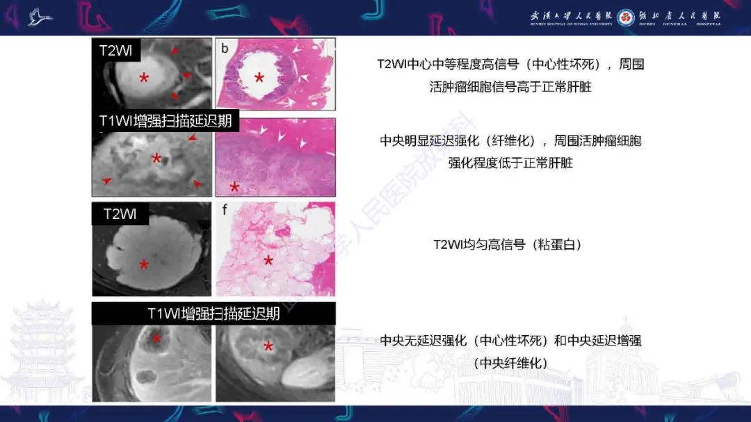 影像PPT - 【PPT】结直肠癌肝转移影像诊断-16