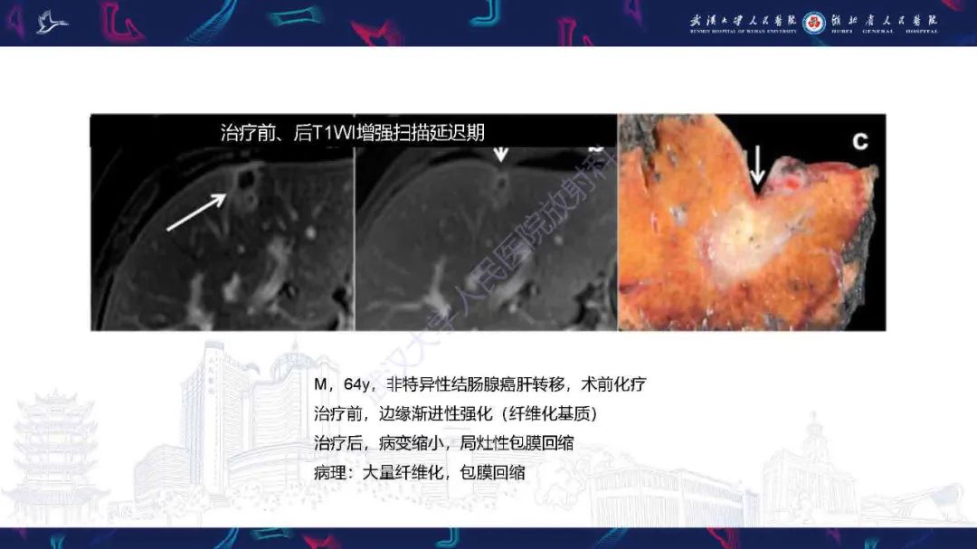 影像PPT - 【PPT】结直肠癌肝转移影像诊断-20