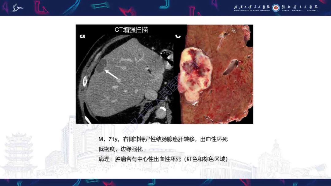 影像PPT - 【PPT】结直肠癌肝转移影像诊断-22