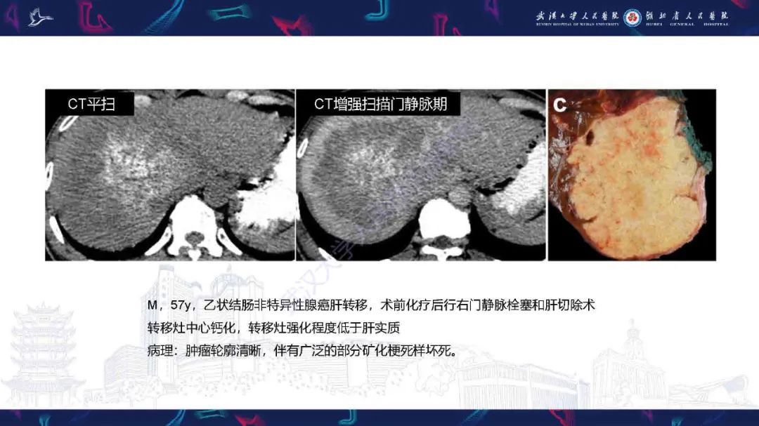 影像PPT - 【PPT】结直肠癌肝转移影像诊断-23