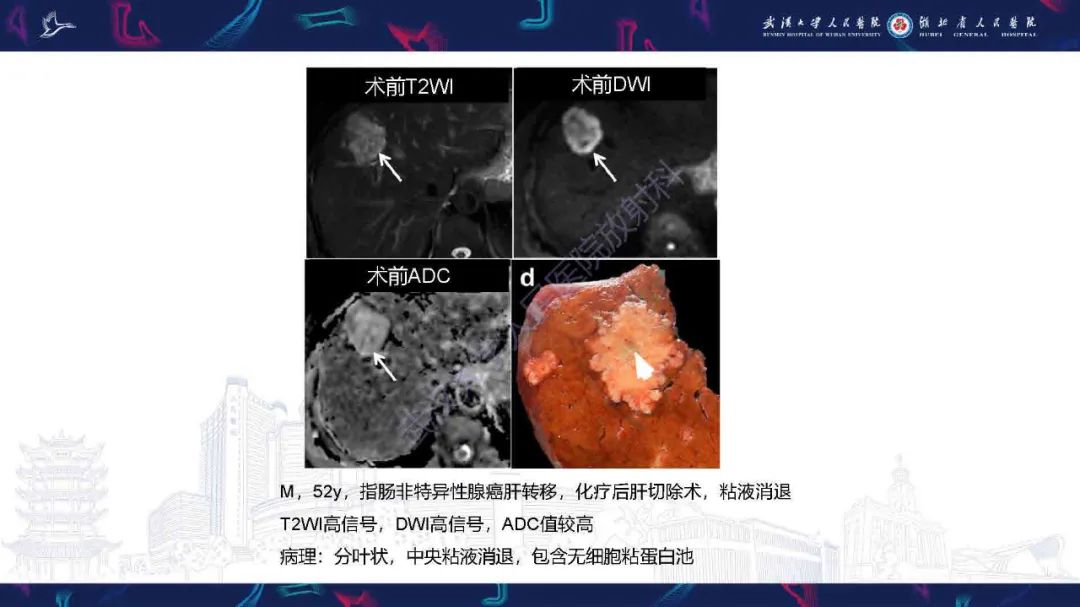影像PPT - 【PPT】结直肠癌肝转移影像诊断-25