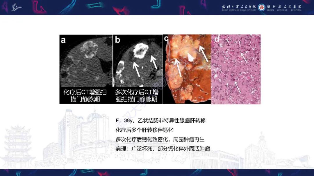 影像PPT - 【PPT】结直肠癌肝转移影像诊断-26