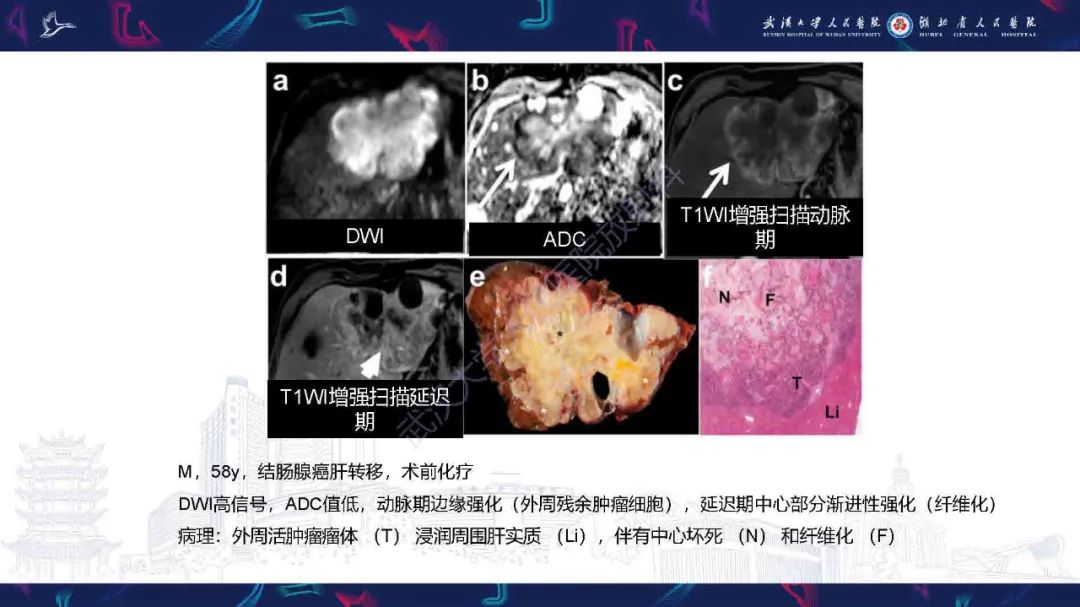 影像PPT - 【PPT】结直肠癌肝转移影像诊断-28