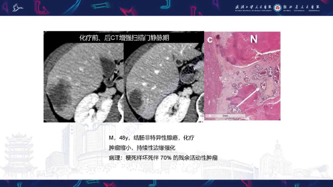 影像PPT - 【PPT】结直肠癌肝转移影像诊断-29