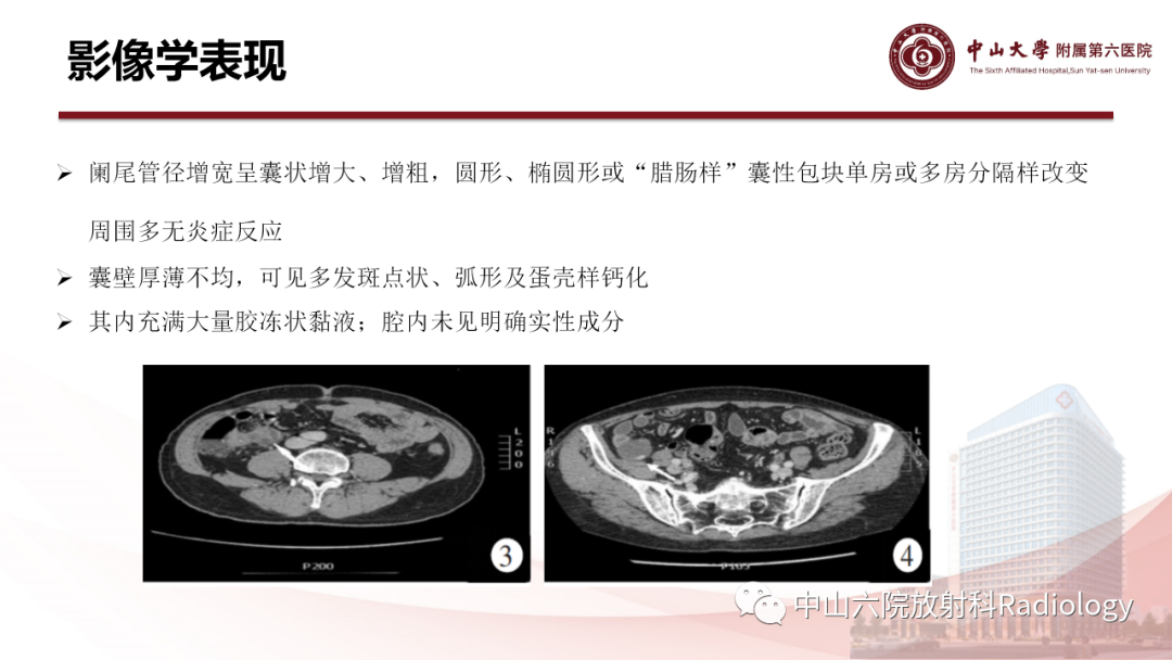 影像PPT - 【PPT】 阑尾低级别黏液性肿瘤影像学表现-5