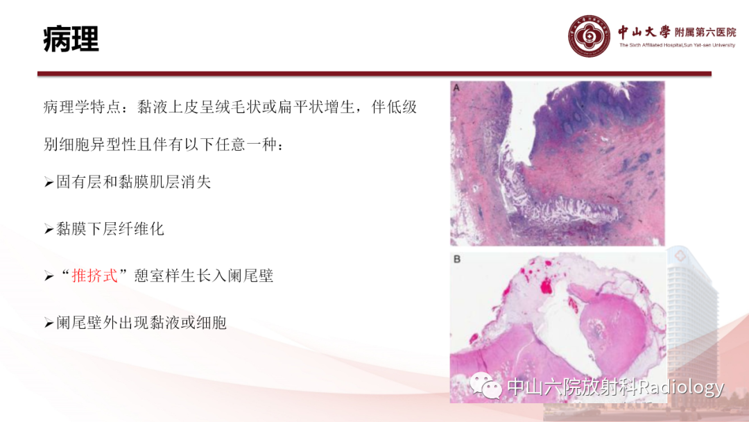 影像PPT - 【PPT】 阑尾低级别黏液性肿瘤影像学表现-4