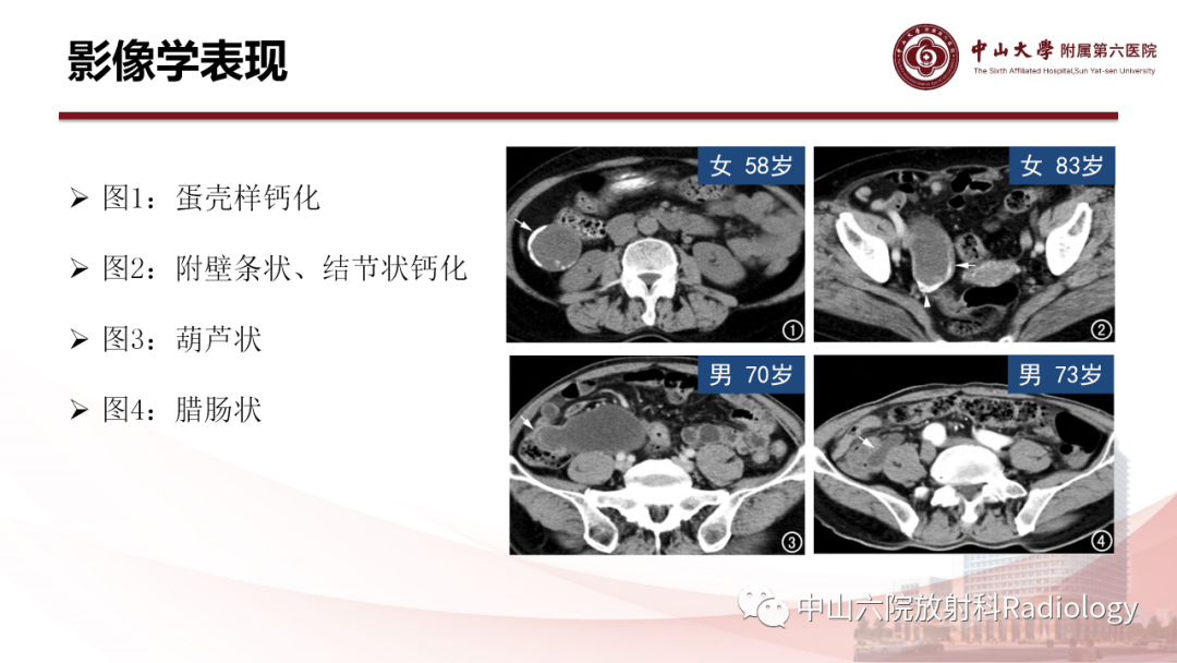 影像PPT - 【PPT】 阑尾低级别黏液性肿瘤影像学表现-6