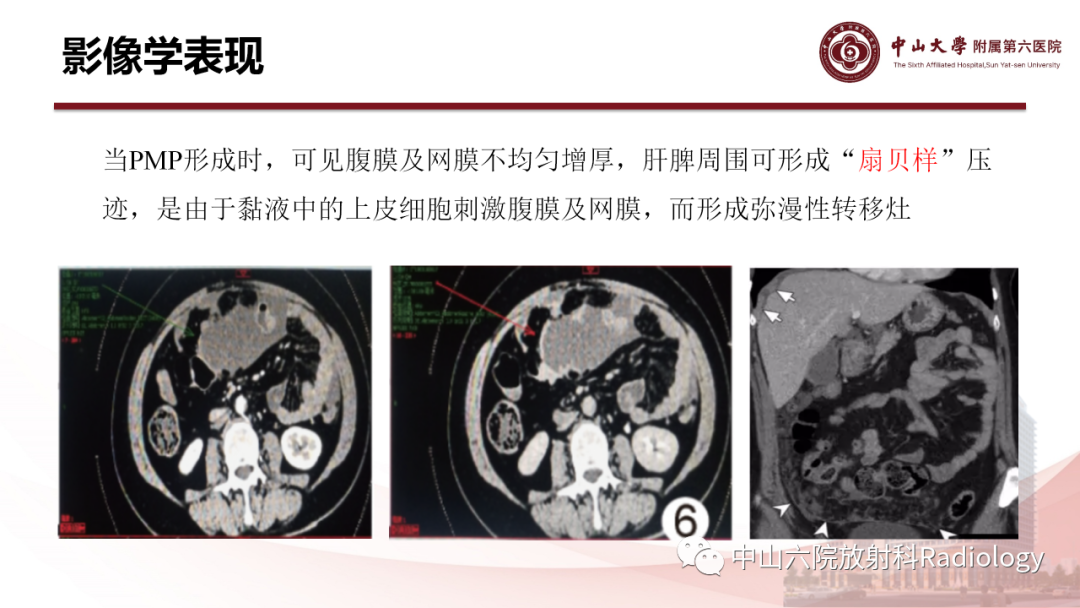 影像PPT - 【PPT】 阑尾低级别黏液性肿瘤影像学表现-8