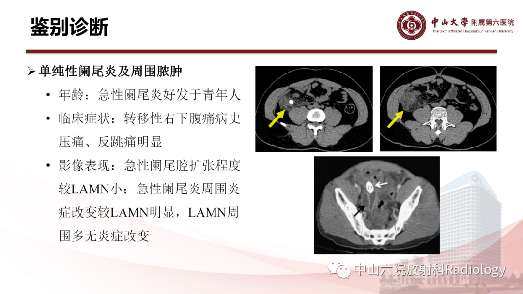 影像PPT - 【PPT】 阑尾低级别黏液性肿瘤影像学表现-12
