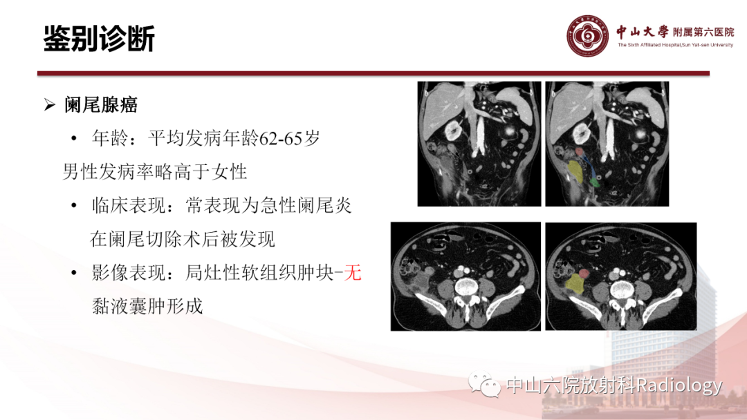 影像PPT - 【PPT】 阑尾低级别黏液性肿瘤影像学表现-13
