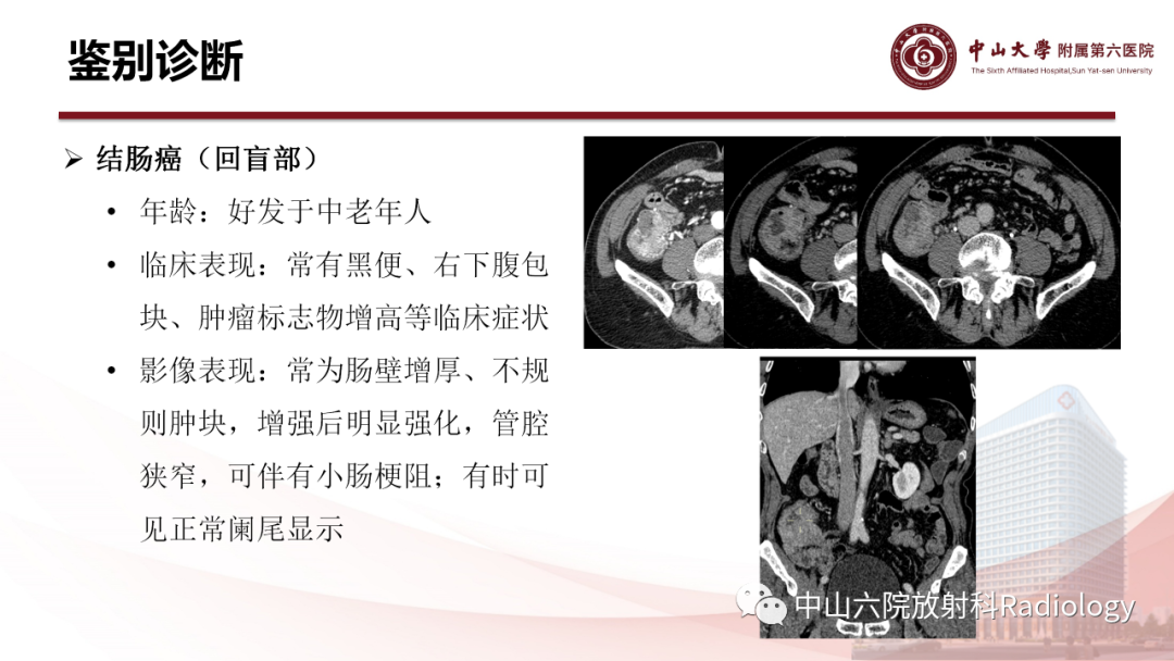 影像PPT - 【PPT】 阑尾低级别黏液性肿瘤影像学表现-14
