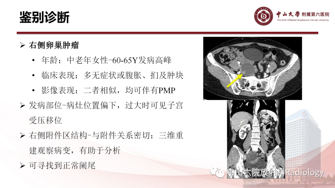 影像PPT - 【PPT】 阑尾低级别黏液性肿瘤影像学表现-15