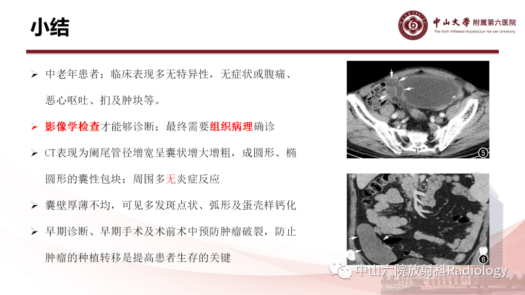 影像PPT - 【PPT】 阑尾低级别黏液性肿瘤影像学表现-16
