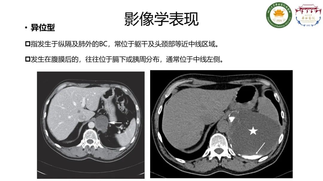 影像PPT - 【病例】支气管源性囊肿1例CT影像-9