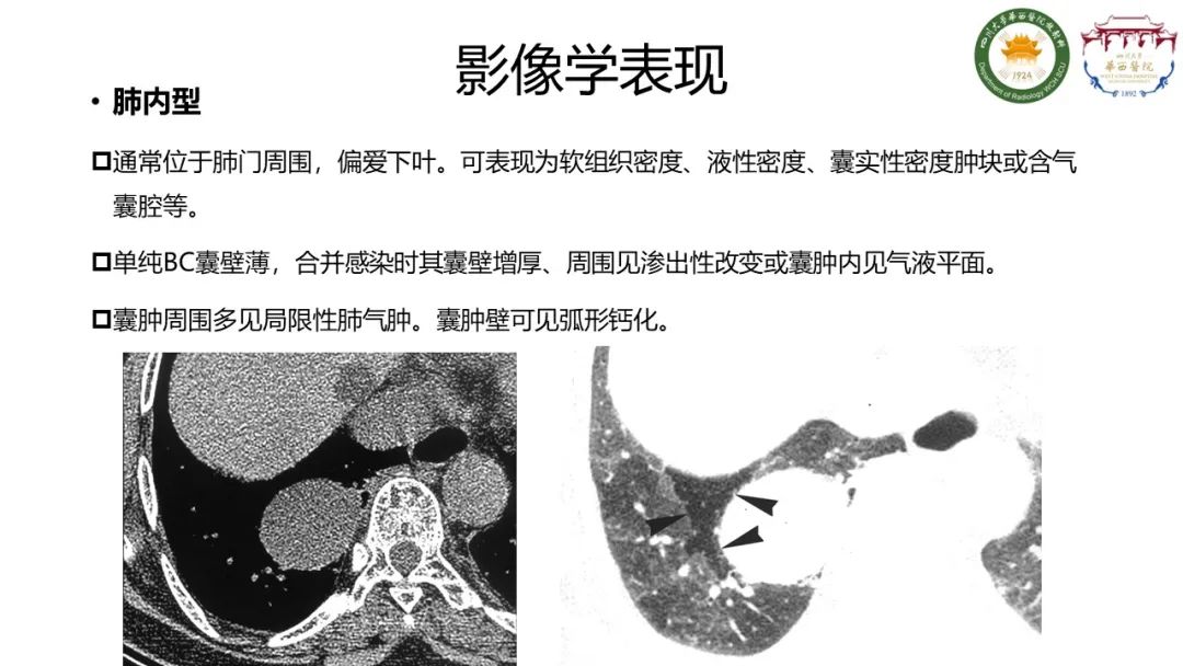 影像PPT - 【病例】支气管源性囊肿1例CT影像-8