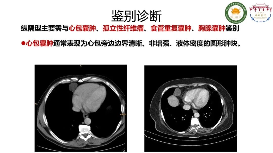 影像PPT - 【病例】支气管源性囊肿1例CT影像-10