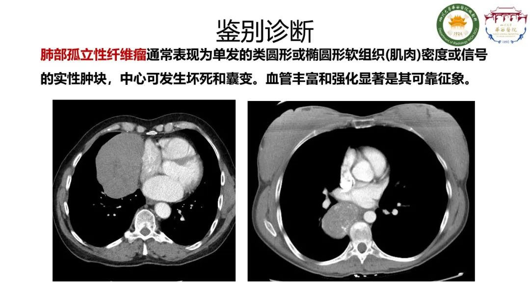 影像PPT - 【病例】支气管源性囊肿1例CT影像-11