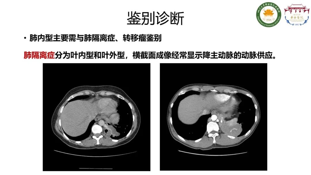 影像PPT - 【病例】支气管源性囊肿1例CT影像-14