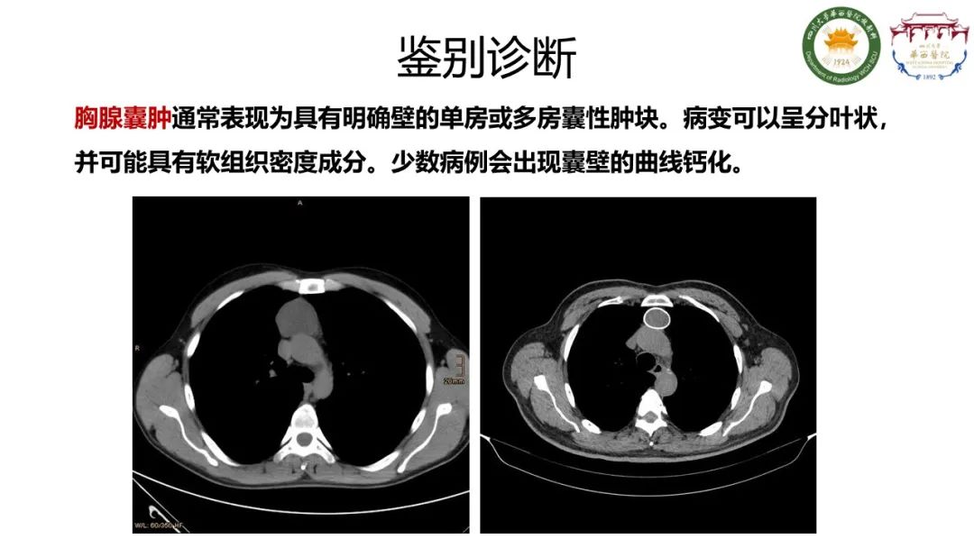 影像PPT - 【病例】支气管源性囊肿1例CT影像-13