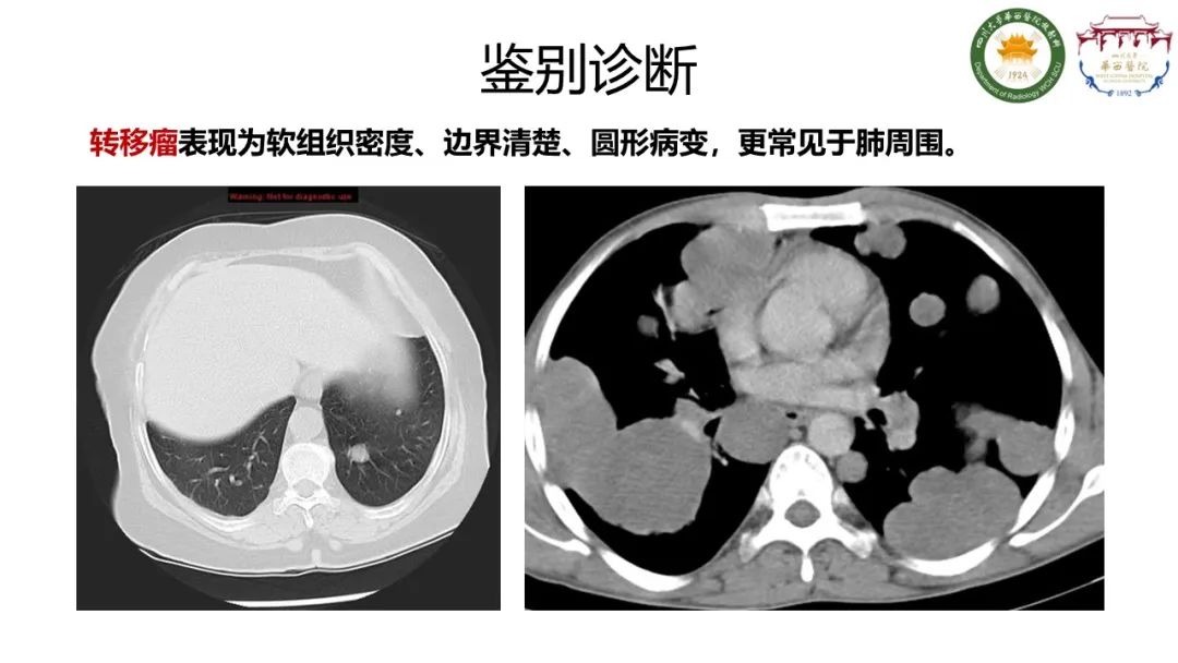 影像PPT - 【病例】支气管源性囊肿1例CT影像-15
