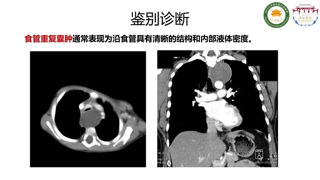 影像PPT - 【病例】支气管源性囊肿1例CT影像-12