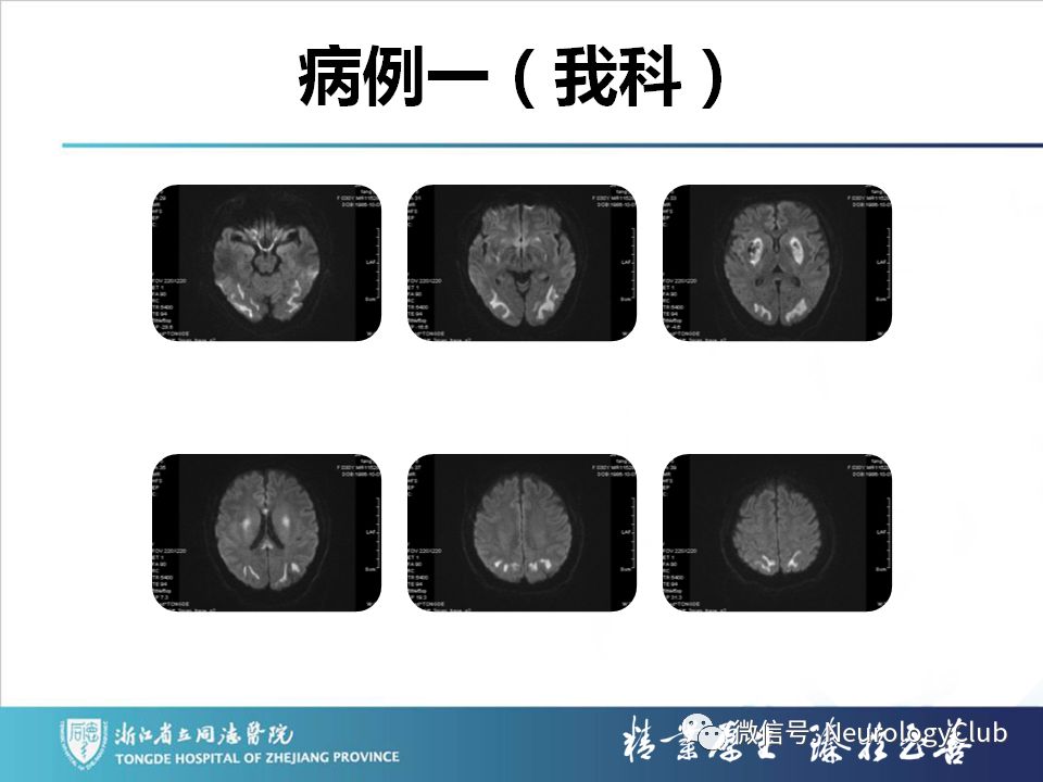 影像PPT - 【PPT】双侧基底节病变的影像诊断和鉴别诊断-11