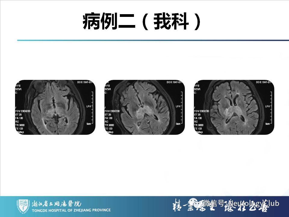 影像PPT - 【PPT】双侧基底节病变的影像诊断和鉴别诊断-14