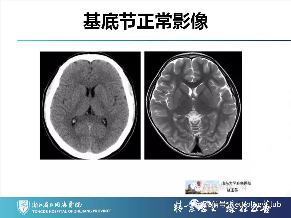 影像PPT - 【PPT】双侧基底节病变的影像诊断和鉴别诊断-18