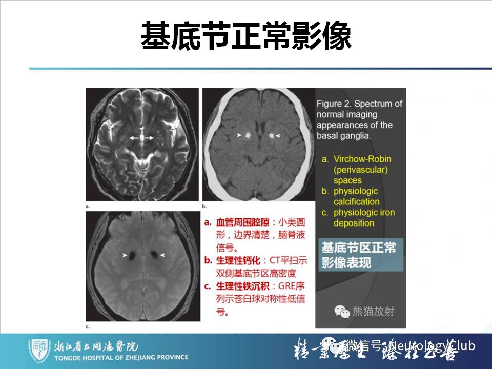 影像PPT - 【PPT】双侧基底节病变的影像诊断和鉴别诊断-20