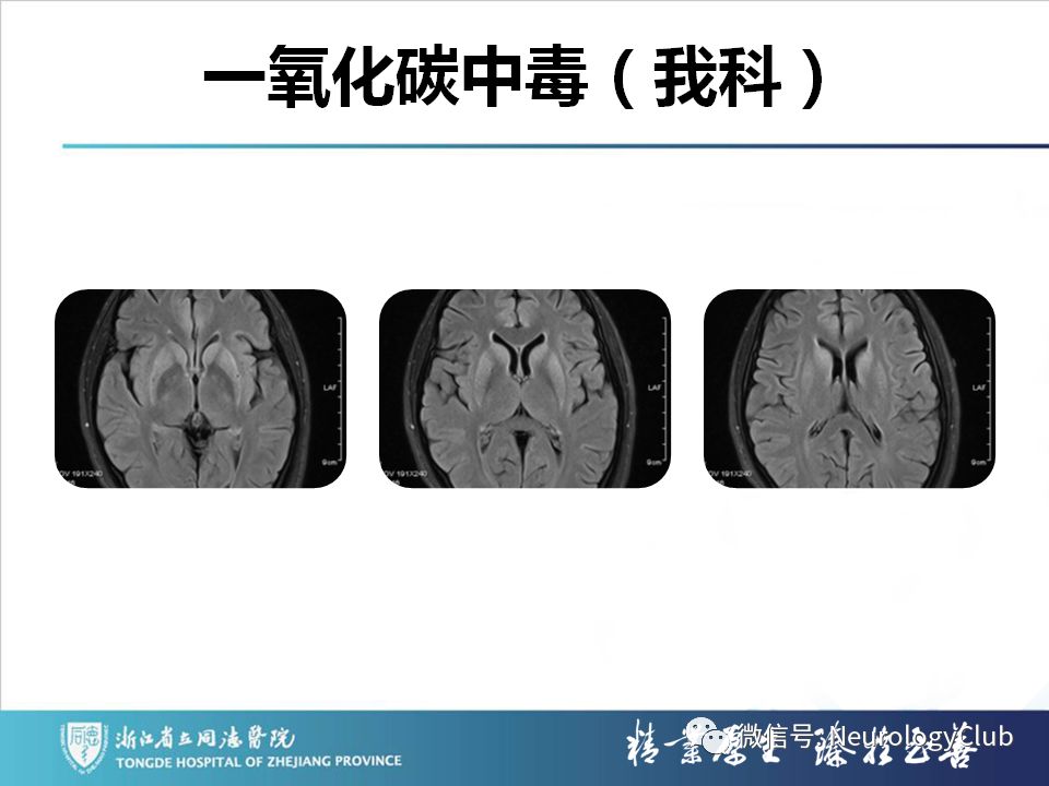 影像PPT - 【PPT】双侧基底节病变的影像诊断和鉴别诊断-27