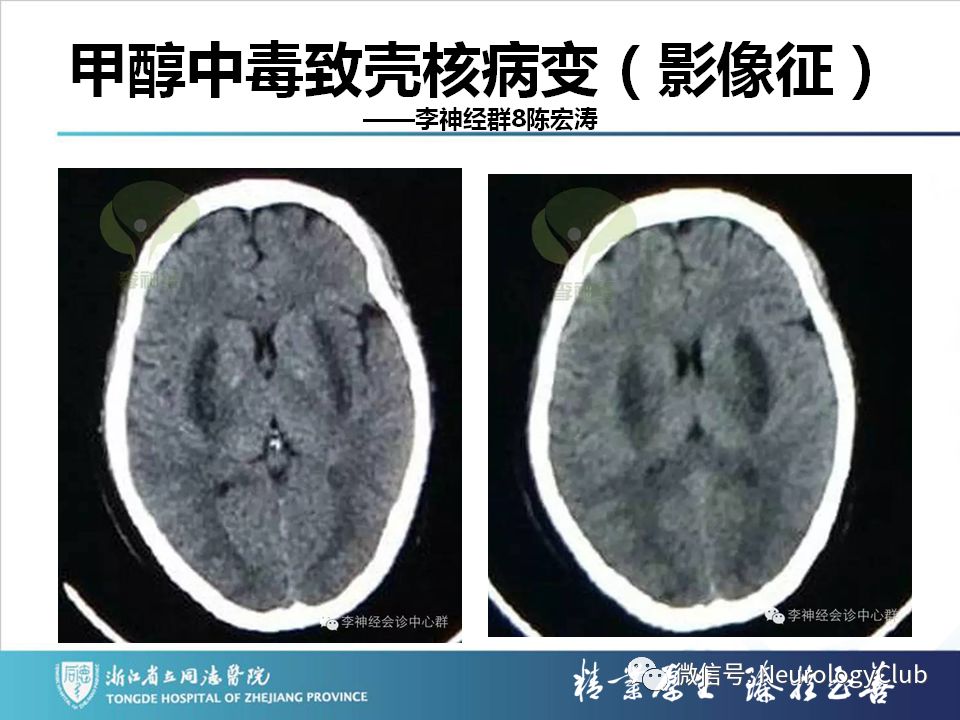 影像PPT - 【PPT】双侧基底节病变的影像诊断和鉴别诊断-30